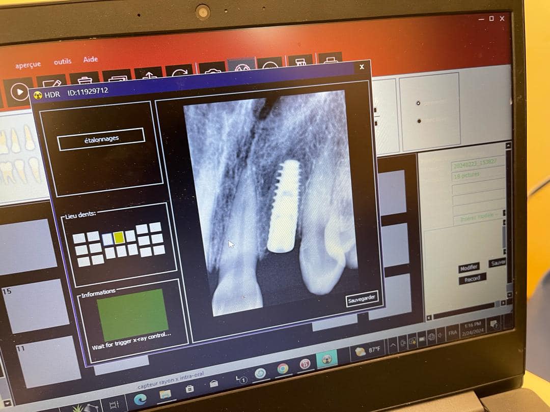 المستشفى الوطني يعلن عن زرع الأسنان لأول مرة داخله (صور)