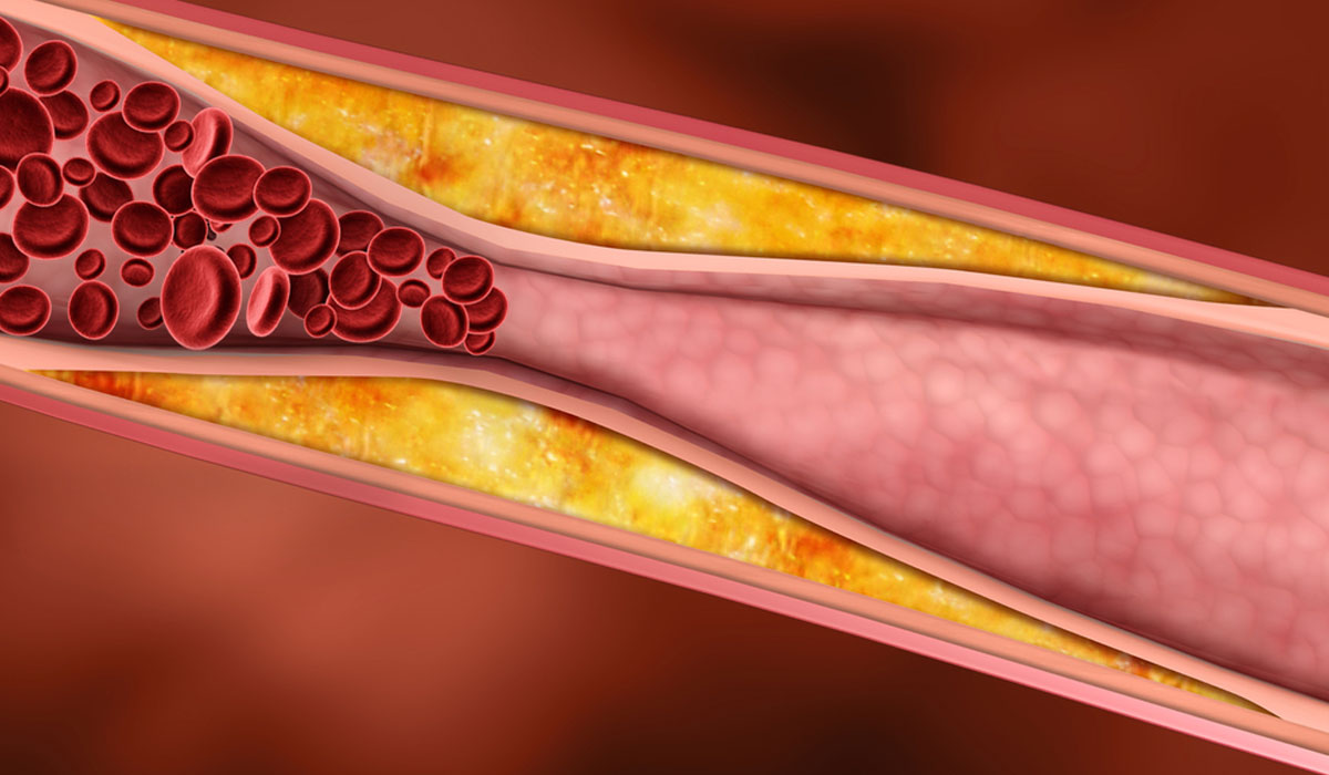 دراسة: هكذا تحمي نفسك من تصلب الشرايين