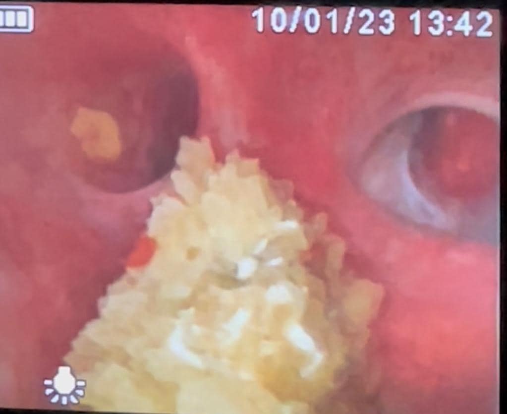 صور من إجراء أول عملية جراحية لحصى الكلى بتقنية الليزر&nbsp;(…)