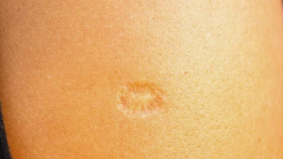 إذا كانت بذراعك هذه العلامة فقد تبعدك عن مخالب كورونا