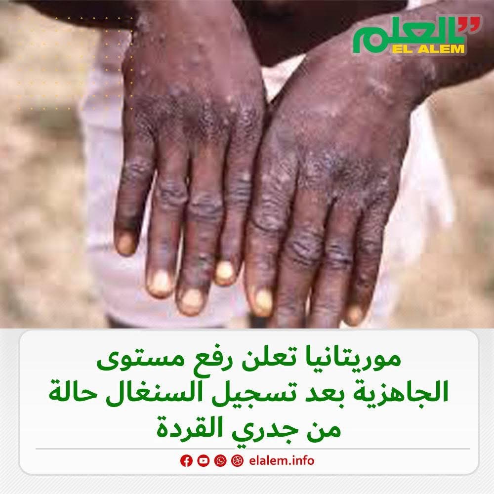 بعد تسجيل السنغال حالة من جدري القدرة.. وزارة الصحة (…)
