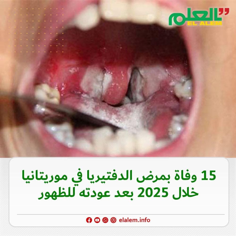 بعد عودته للظهور.. 15 وفاة بسبب مرض الدفتيريا في (…)